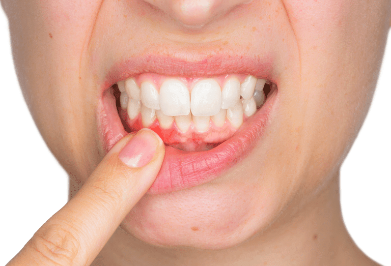 Receding Gums Treatment